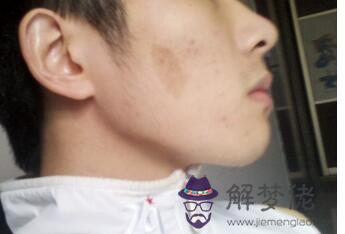 有胎記的孩子是什麼來的：胎記的傳說都有哪些