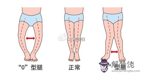 小孩走路腳內八字怎麼辦