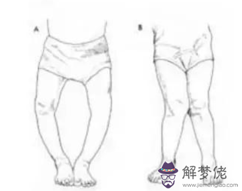 寶寶有點內八字怎麼矯正