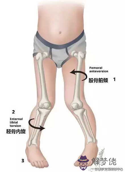 小孩有點內八字怎麼辦：一歲多的寶寶走路有點內八字