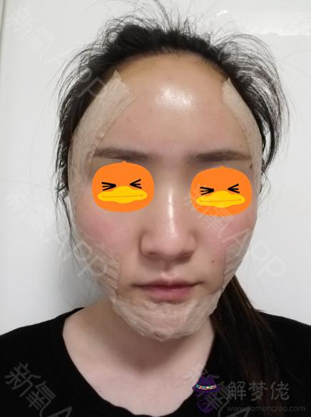 鼻子兩邊有一道痕,像是長期兩邊測睡引起的,像大八字貼在臉上,難看死了,我該怎