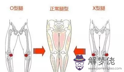 孩子外八字腳怎麼矯正