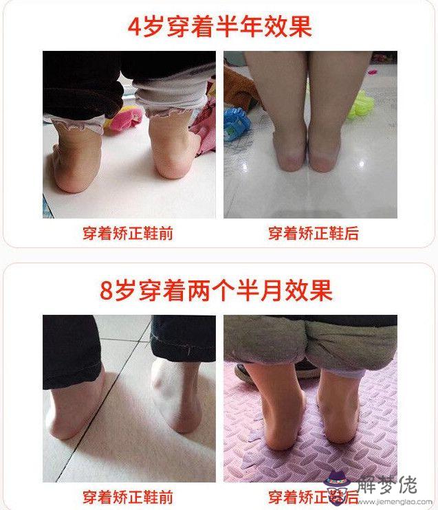 外八字腳如何矯正：孩子外八字腳怎麼校正