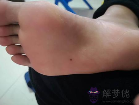 男人右腳腳底有痣是吉還是兇