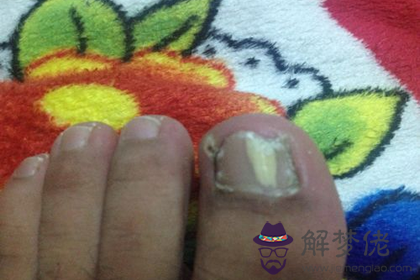 灰指甲會給自己帶來什么運勢影響(圖文)