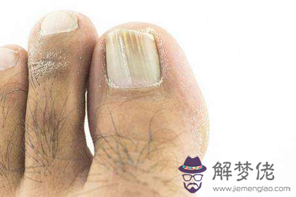 灰指甲會給自己帶來什么運勢影響(圖文)