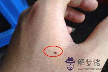 手上長痣長在手眼部位好不好呢(圖文)
