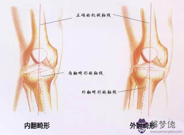 小孩腿外八字能矯正嗎