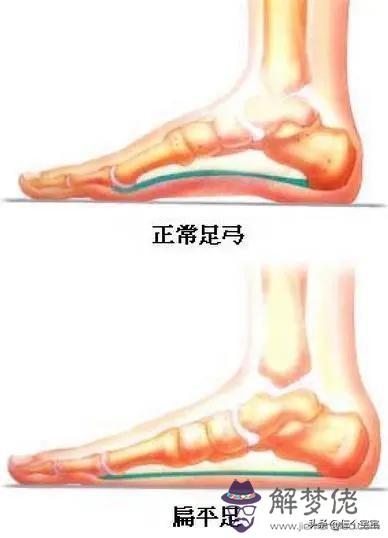 女生走路外八字腳原因