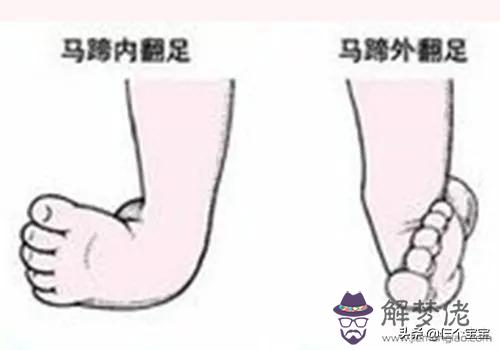 女生走路外八字腳原因