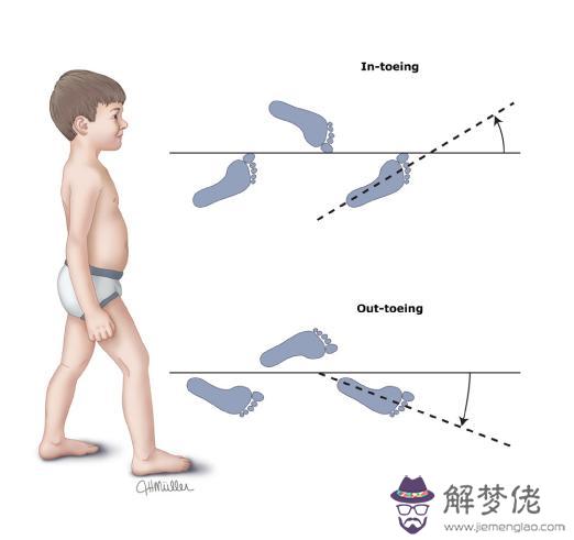 幼兒腿直但走路內八字