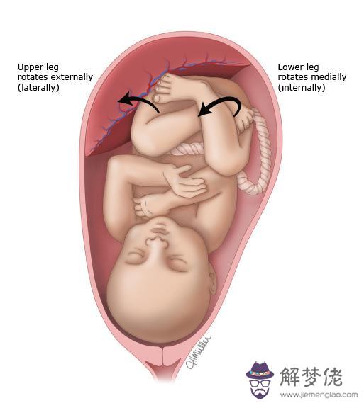 幼兒腿直但走路內八字