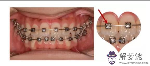 牙齒矯正八字結扎作用
