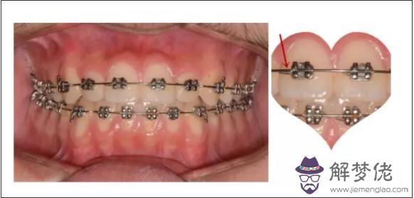 牙齒矯正八字結扎作用