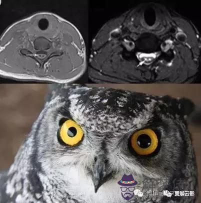 頸髓橫斷面八字征 頸髓橫斷面八字征
