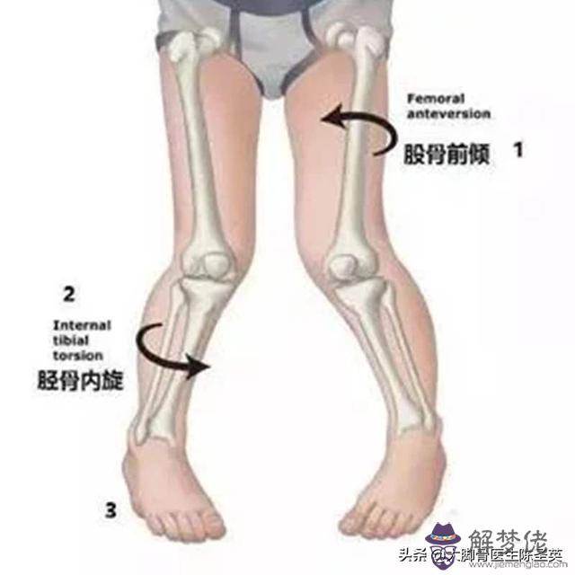 十歲女孩內八字走路怎麼糾正