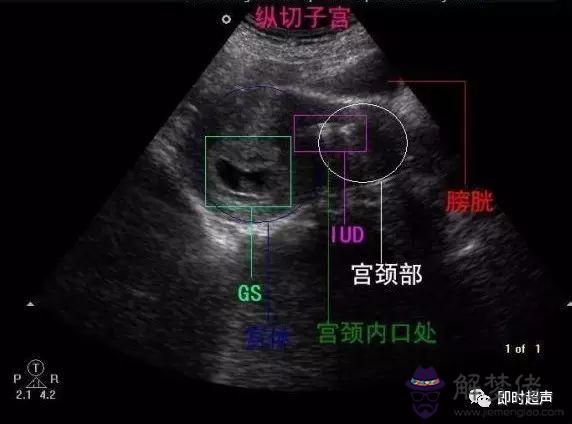 子宮內膜呈八字形是什麼意思