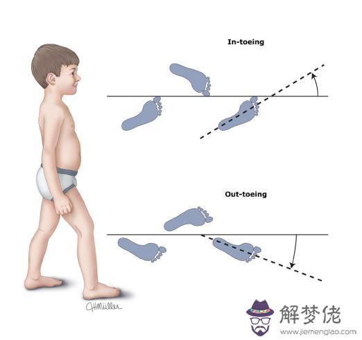 寶寶跑步外八字