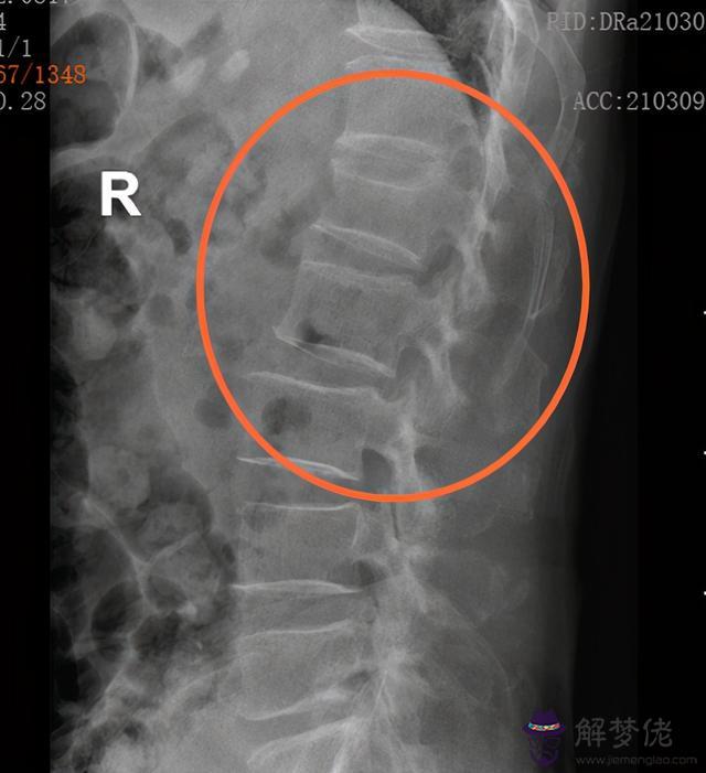 腰椎骨骨折八字分析