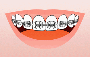 牙套鋼絲那個八字環繞叫什麼意思