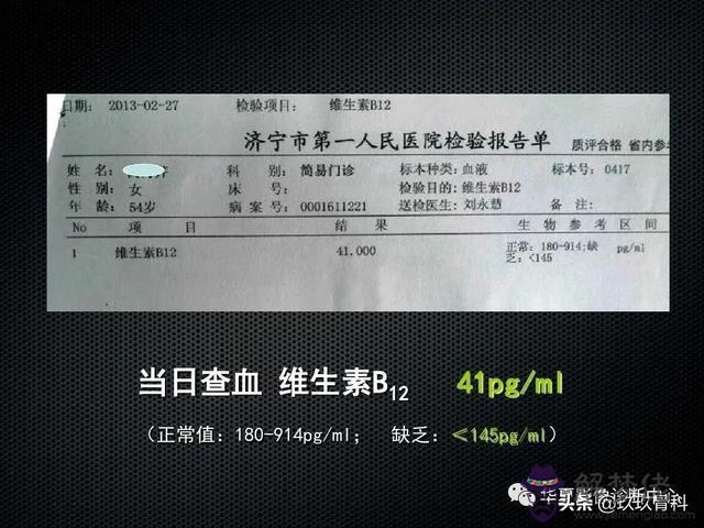 脊髓亞急性聯合變性八字征
