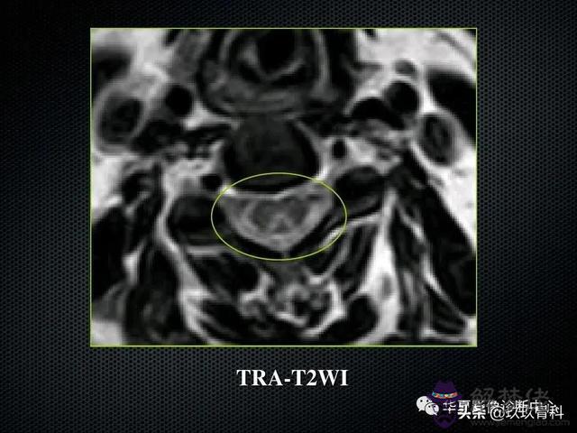 脊髓亞急性聯合變性八字征