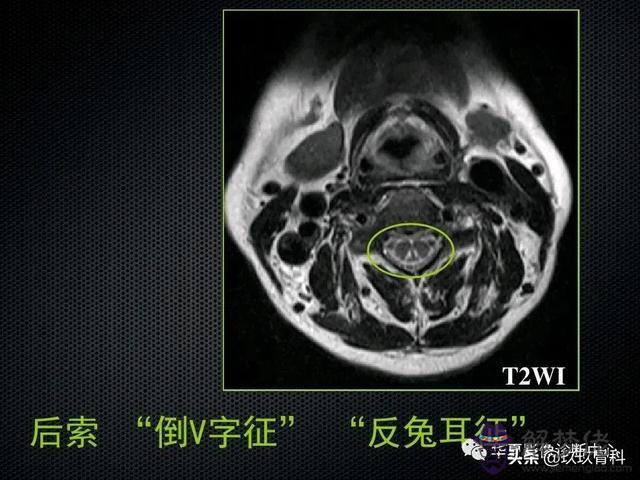 脊髓亞急性聯合變性八字征