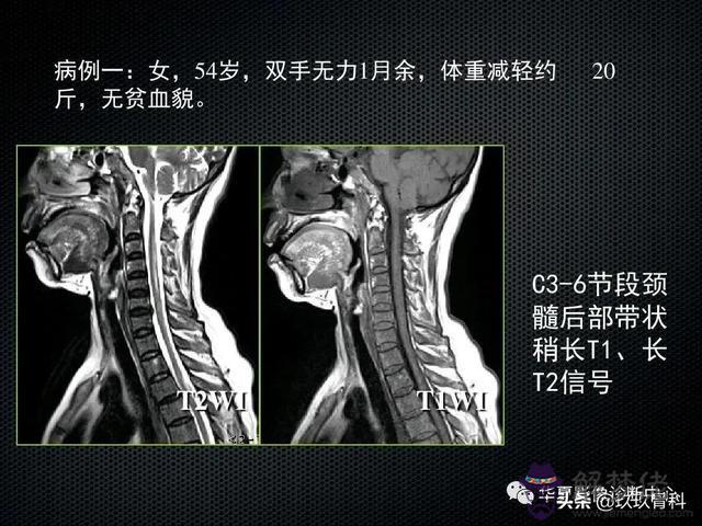 脊髓亞急性聯合變性八字征