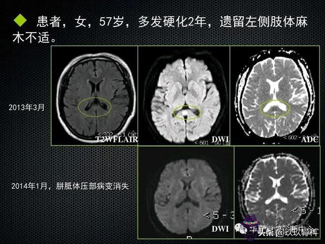 脊髓亞急性聯合變性八字征