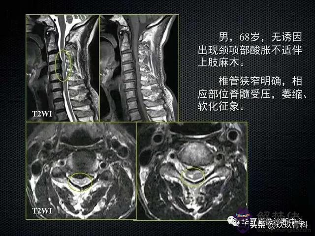 脊髓亞急性聯合變性八字征