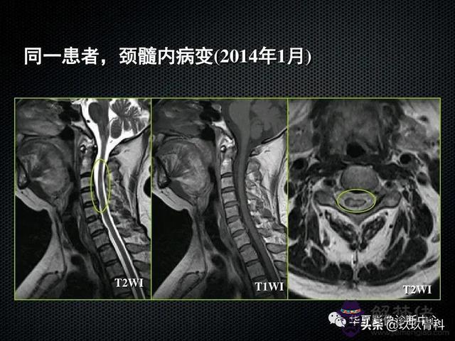 脊髓亞急性聯合變性八字征