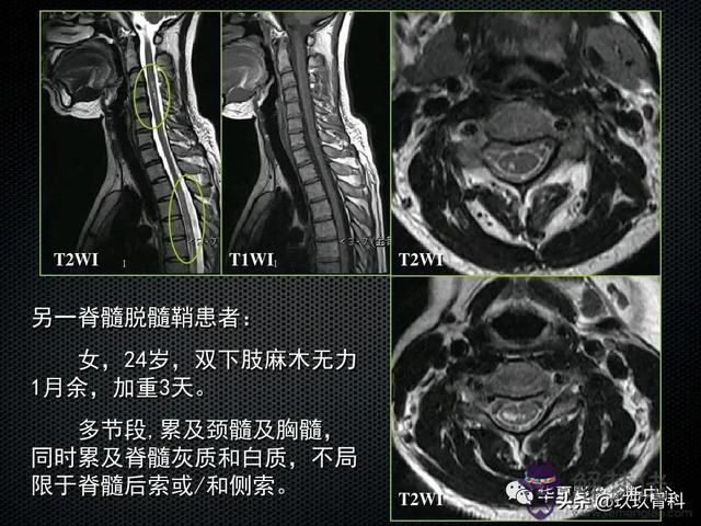 脊髓亞急性聯合變性八字征