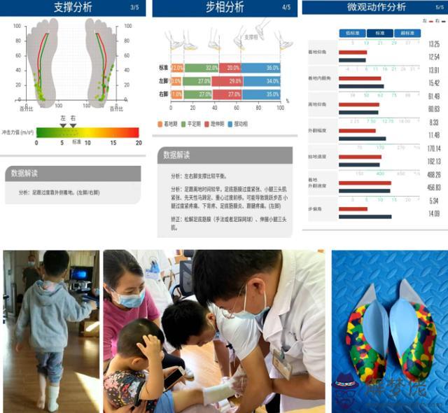 湖南湘雅醫院兒童內八字