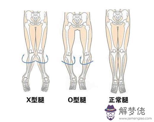 新生兒腳有點內八字怎麼辦