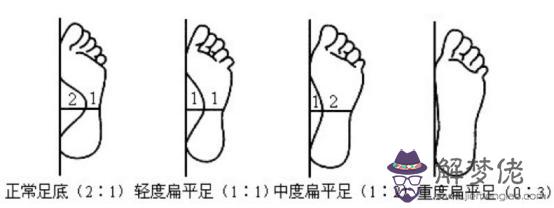扁平足會導致內八字大拇腳趾向里