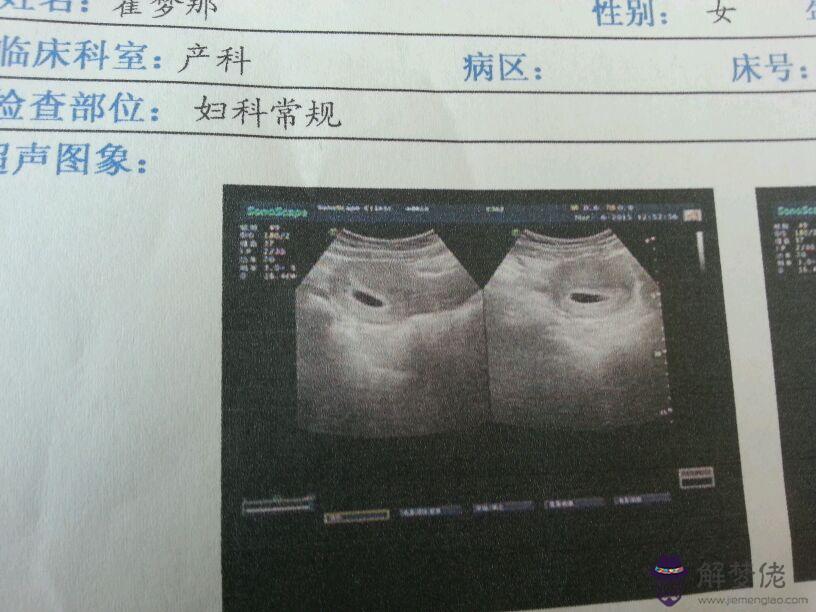 1、懷孕初期最準女兒特征:各位懷女兒的時候都有什麼明顯特征嗎？