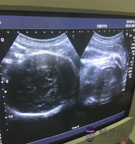 3、懷孕多久b超能看出男女:懷孕20周胎兒四維彩超圖是什麼樣子的？