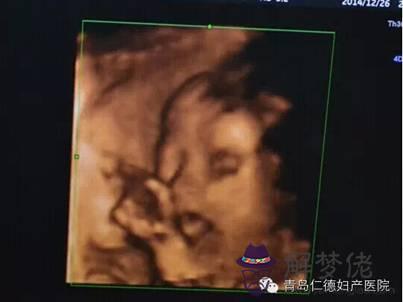 4、四維彩超報告單解讀:四維彩超單怎麼看是男孩還是女孩？