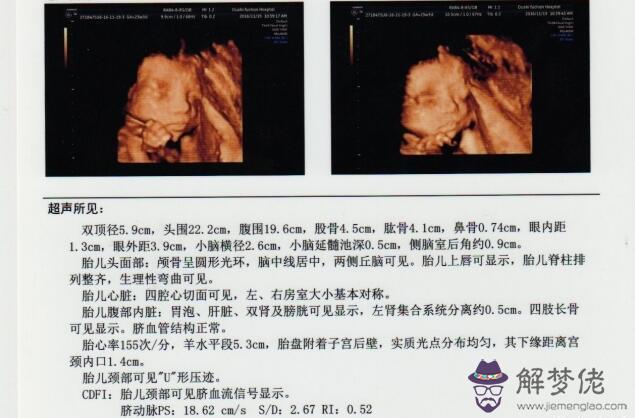 1、女胎兒四維彩超圖片:懷孕20周胎兒四維彩超圖是什麼樣子的？