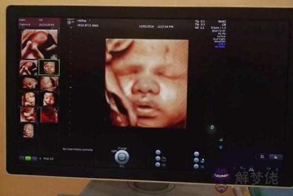 5、女胎兒四維彩超圖片:四維彩超照片能不能看出男孩女孩