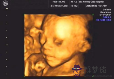 4、女胎兒四維彩超圖片:四維彩超看胎兒性別