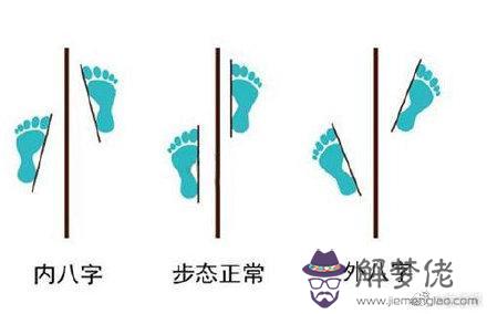 內八字手術能矯正嗎 內八字手術能矯正嗎