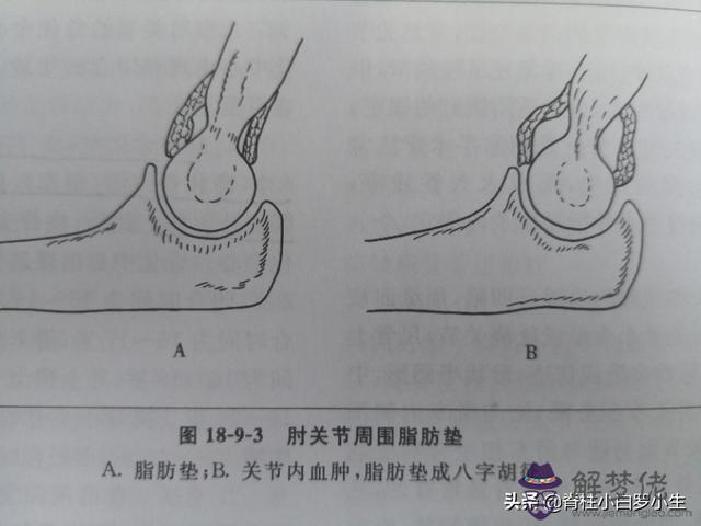 肘關節八字征如何處理