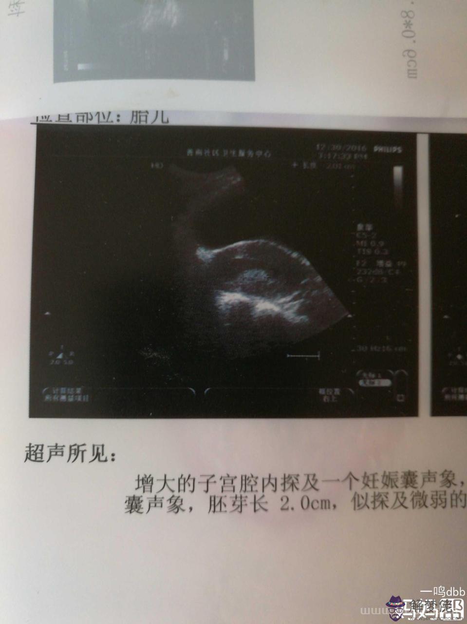 懷孕10幾天能打掉嗎，懷孕20多天可以做流產嗎