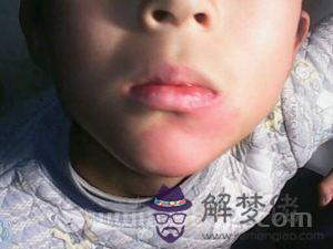 下巴上的胎記有哪些說法? 下巴上的胎記有哪些說法?