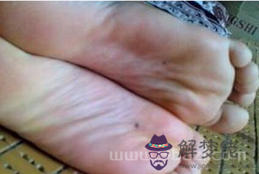 女人右腳底有痣詳解 注意痣的具體位置