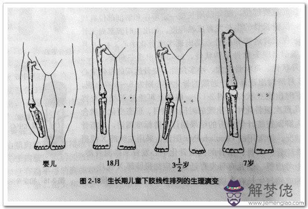 2、佝僂病的六中婚式:佝僂病的三個癥狀,三個體征、三個誘因、三個步驟