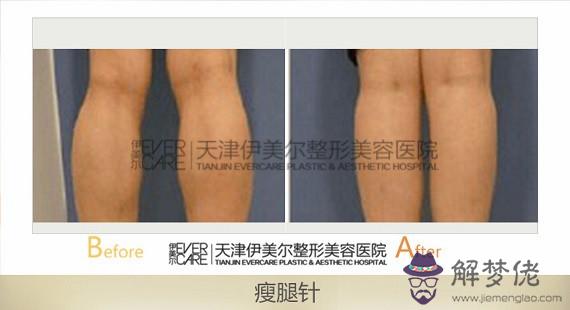 針反彈后會更粗嗎:我腿粗,針會反彈嗎?
