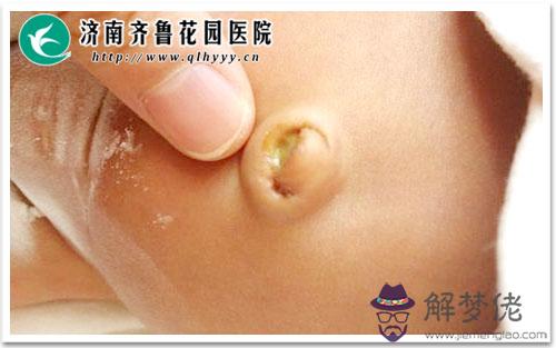 新生兒有點怎麼辦:寶寶快一個月了,可是還有點,怎麼辦