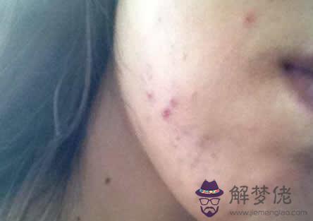 臉頰兩側突然長了好多這樣的痘痘,是什麼原因引起的,應該怎麼護理?